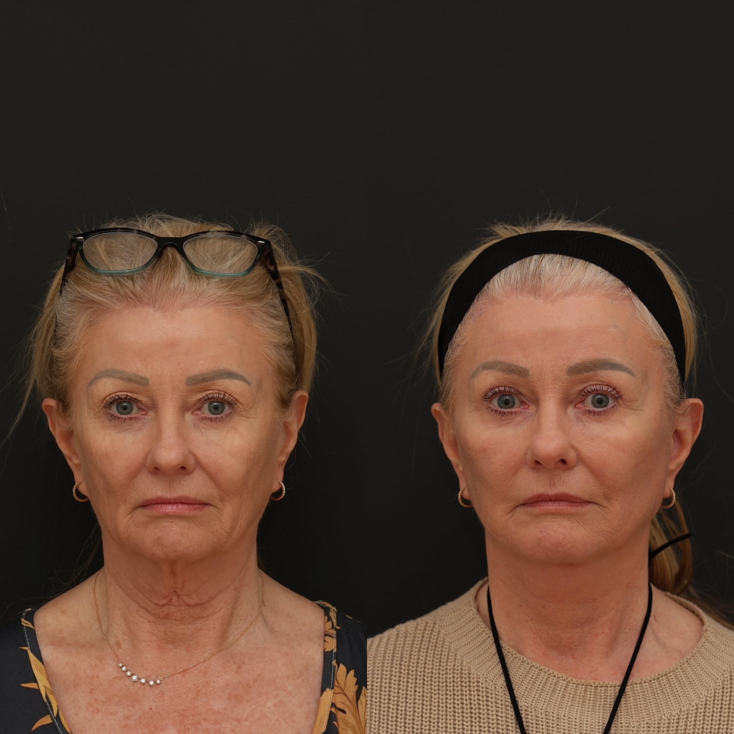 Facelift  Gallery Before & After