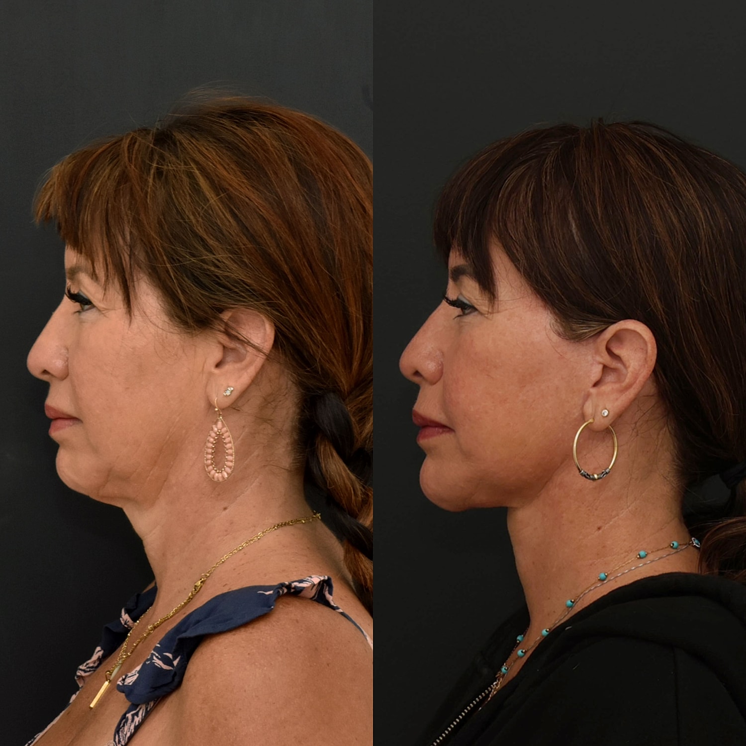 Facelift  Gallery Before & After
