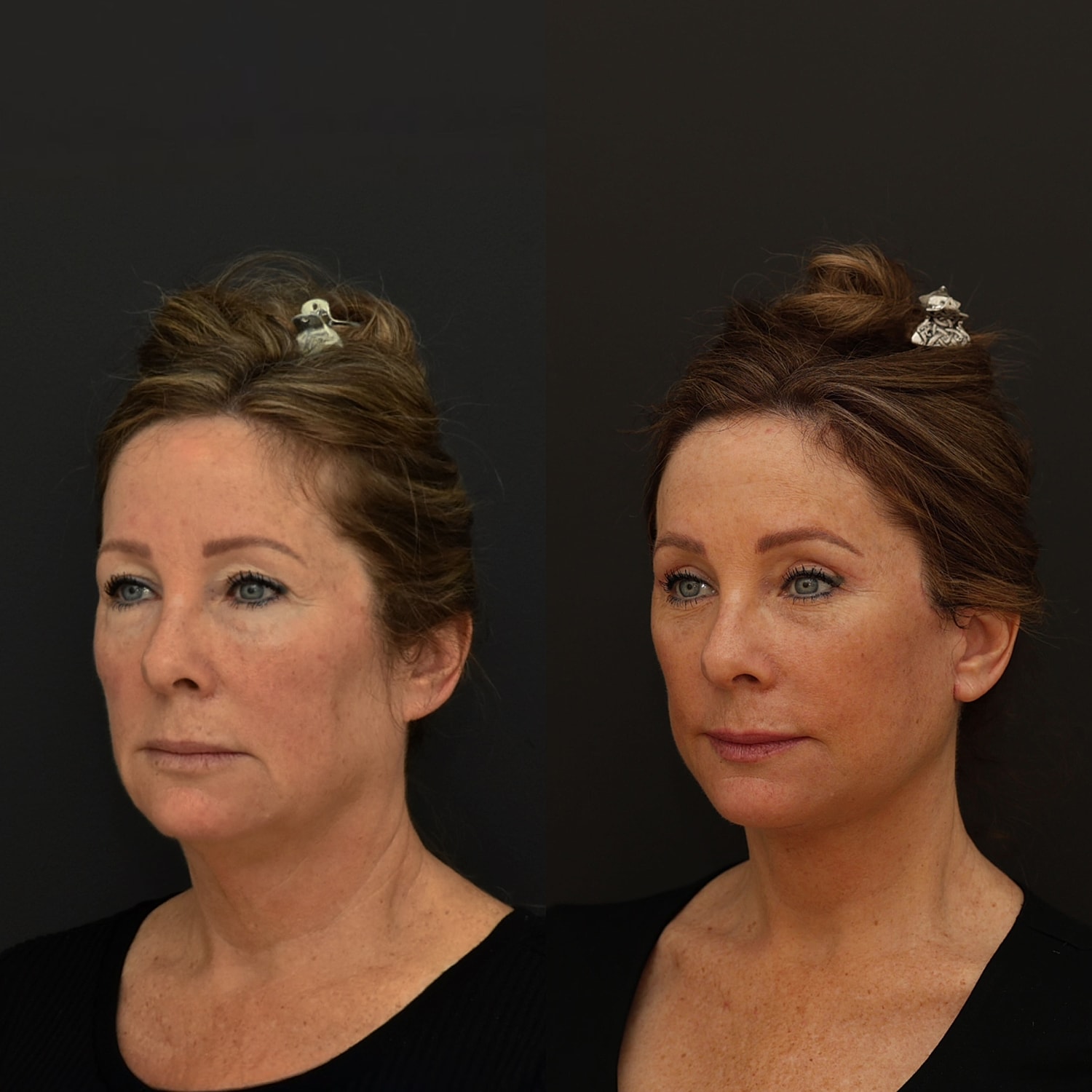 Facelift  Gallery Before & After