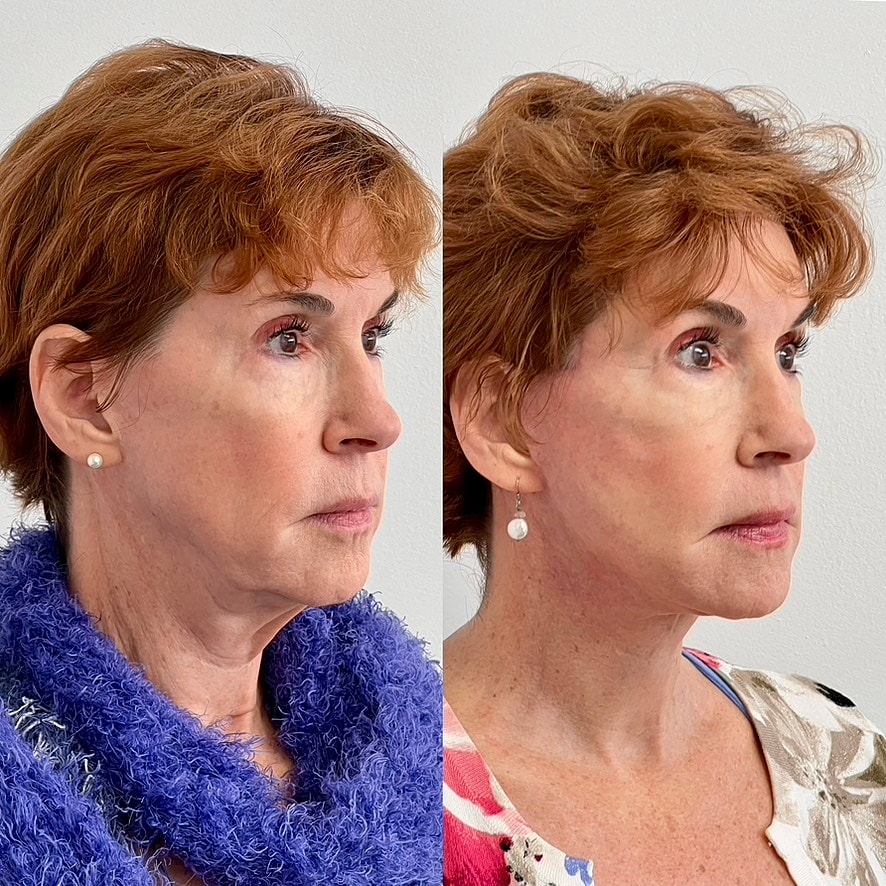 Facelift  Before & After