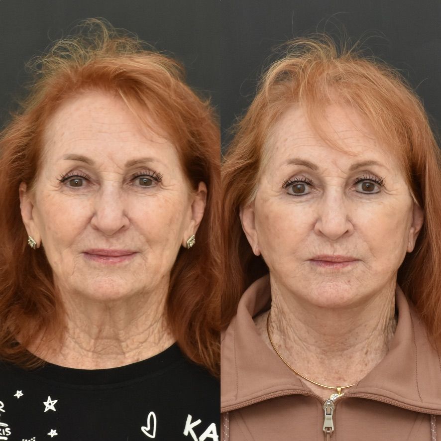 Facelift  Before & After