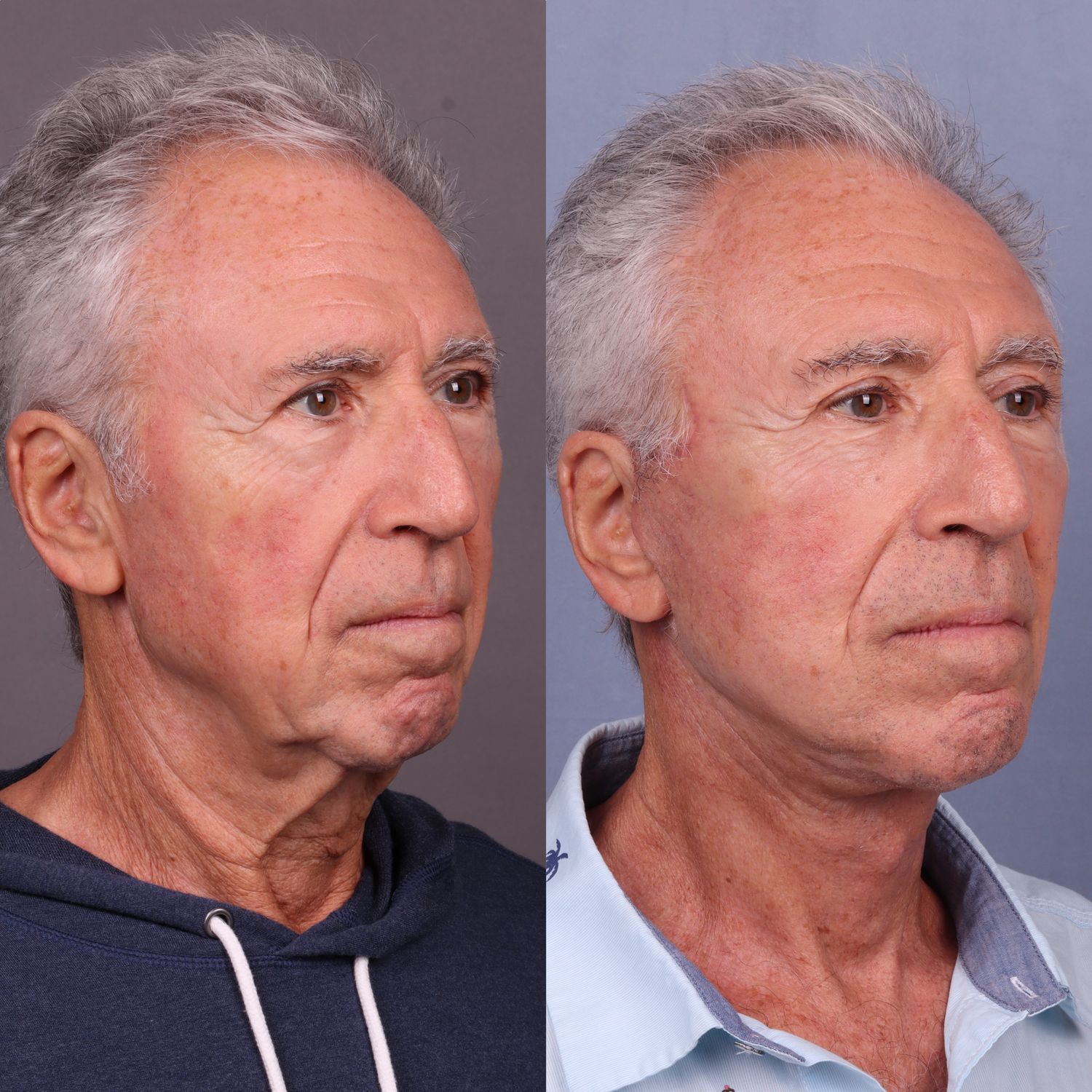 Before and after facial rejuvenation treatment comparison.