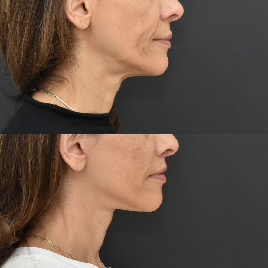 Facelift  Before & After