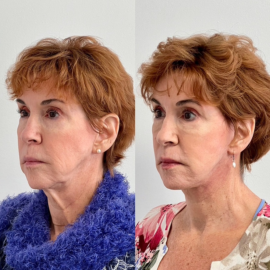Facelift  Before & After