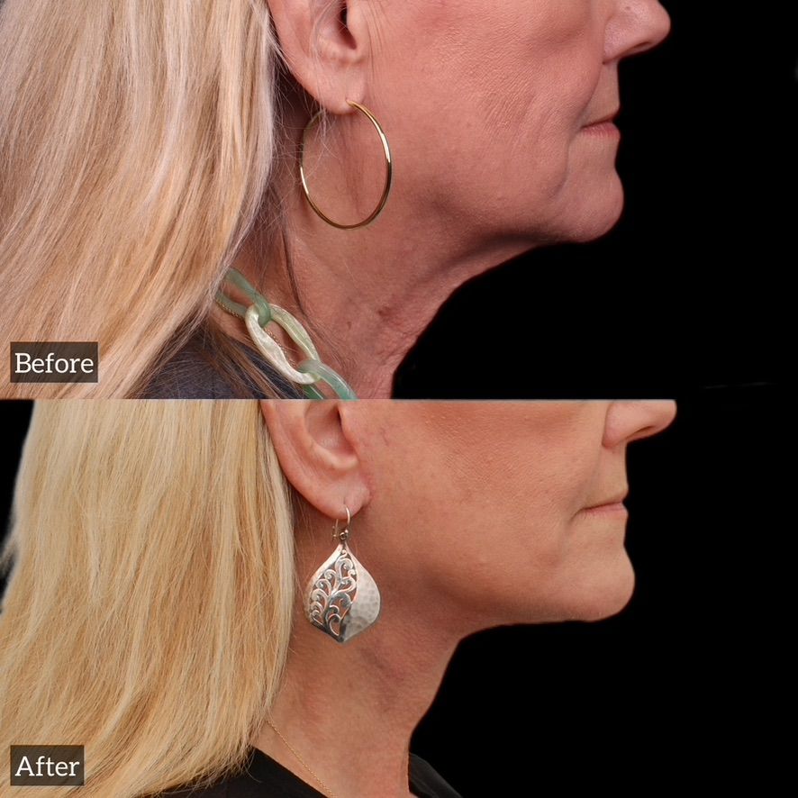 Facelift  Before & After
