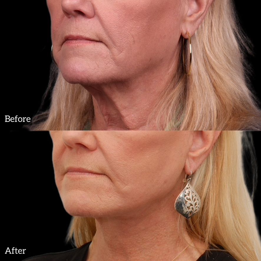 Facelift  Before & After