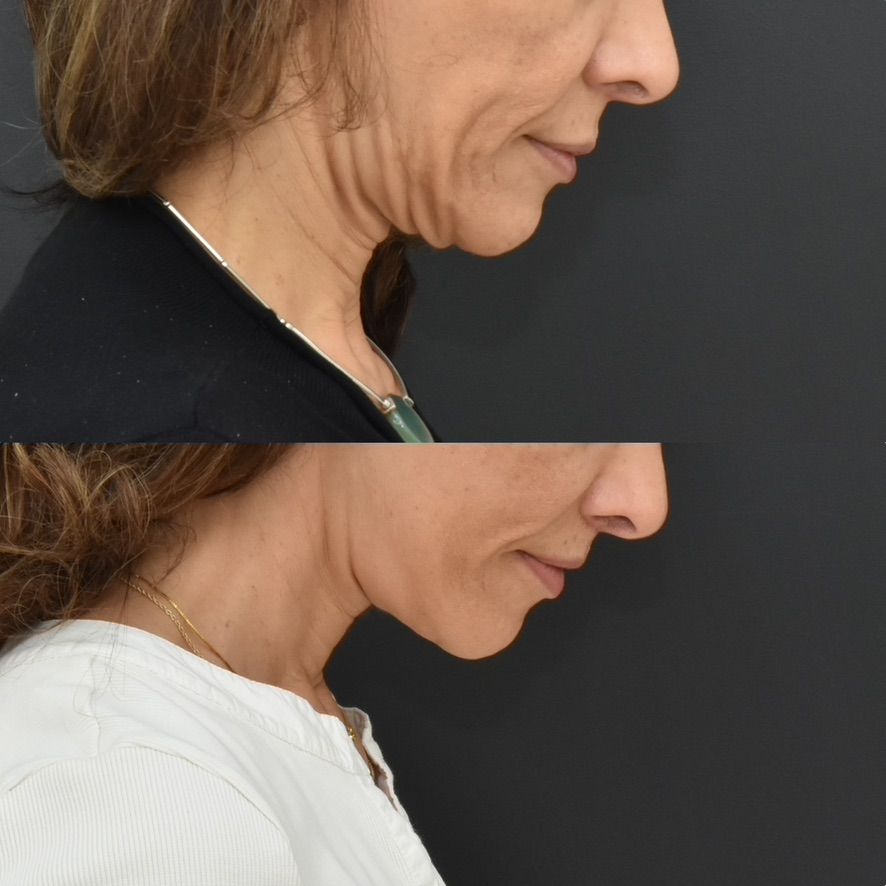 Facelift  Before & After