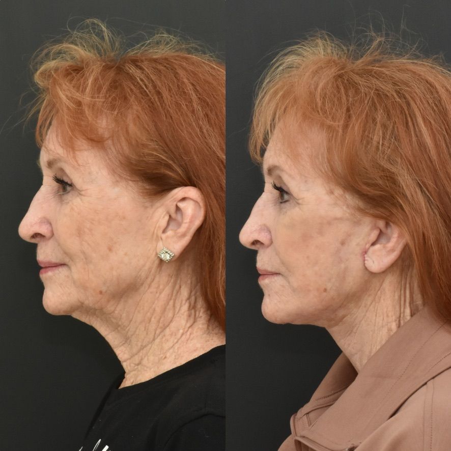 Facelift  Before & After
