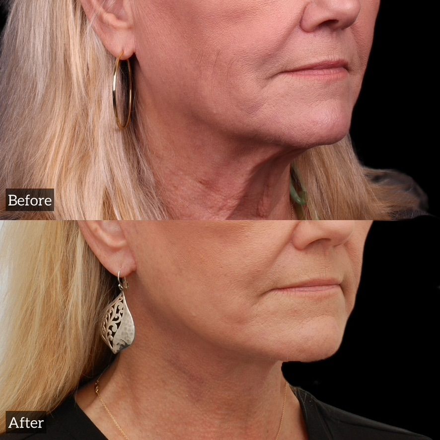 Facelift  Before & After
