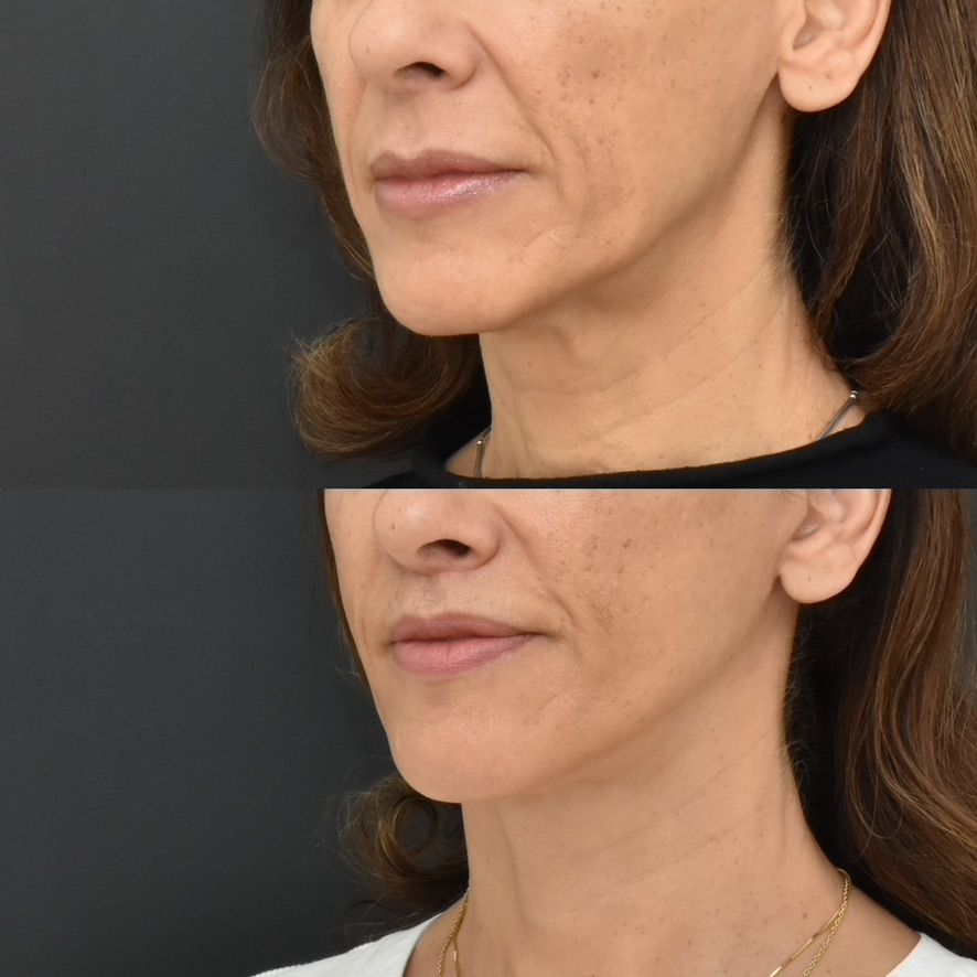 Facelift  Before & After