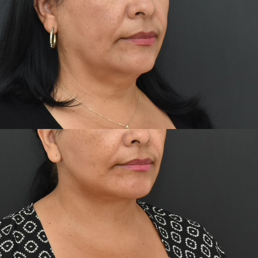 Facelift  Before & After