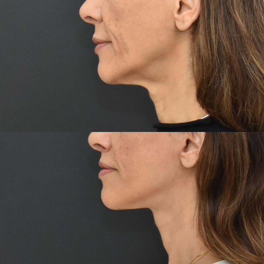 Facelift  Before & After
