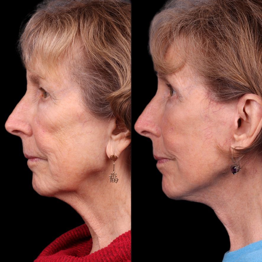Facelift  Before & After