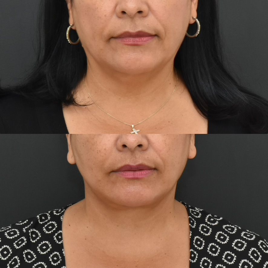 Facelift  Before & After