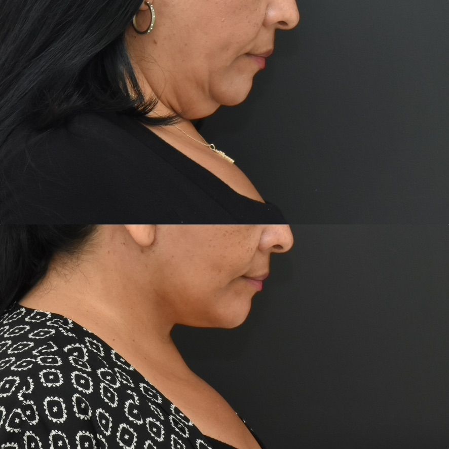 Facelift  Before & After