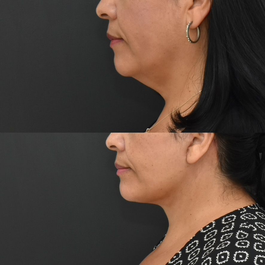 Facelift  Before & After