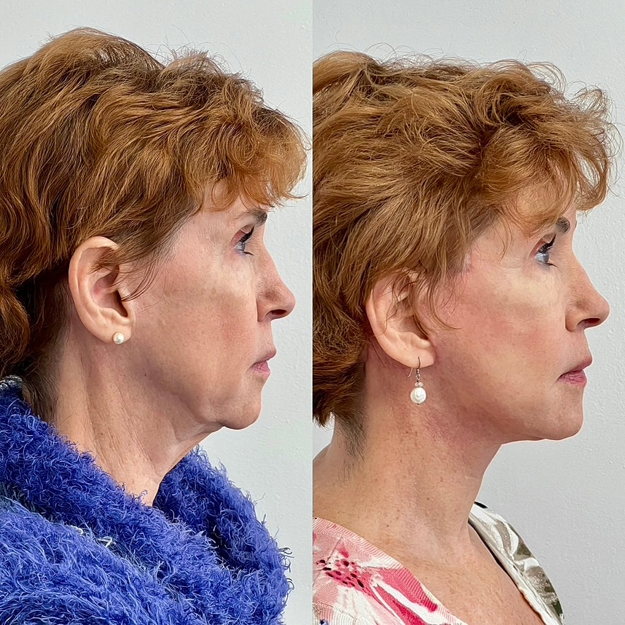 Facelift  Before & After