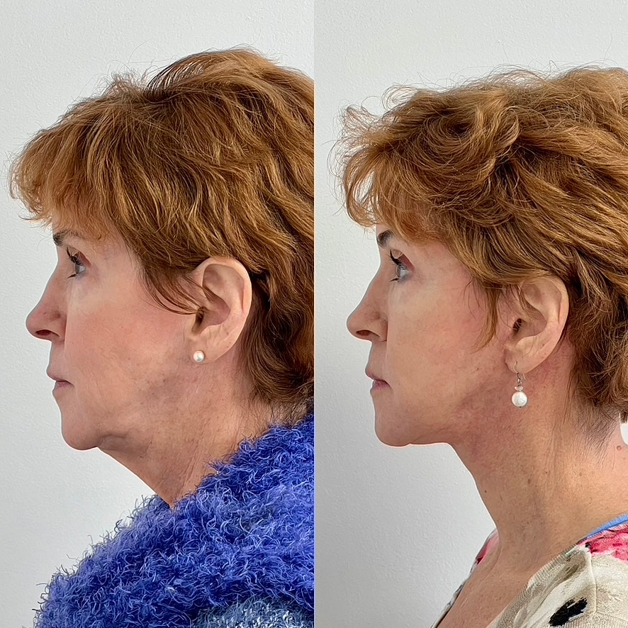 Facelift  Before & After