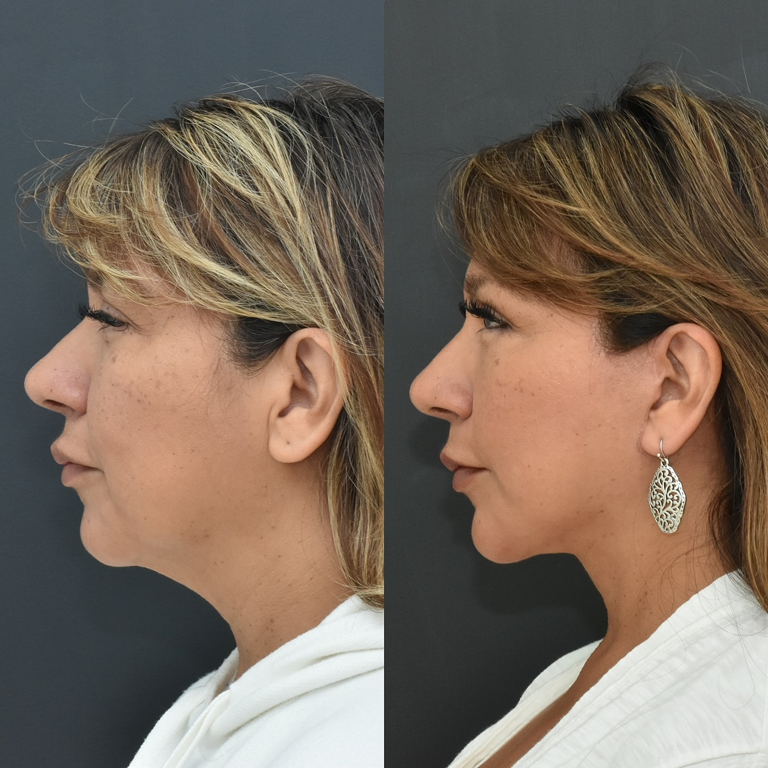 Facelift  Before & After