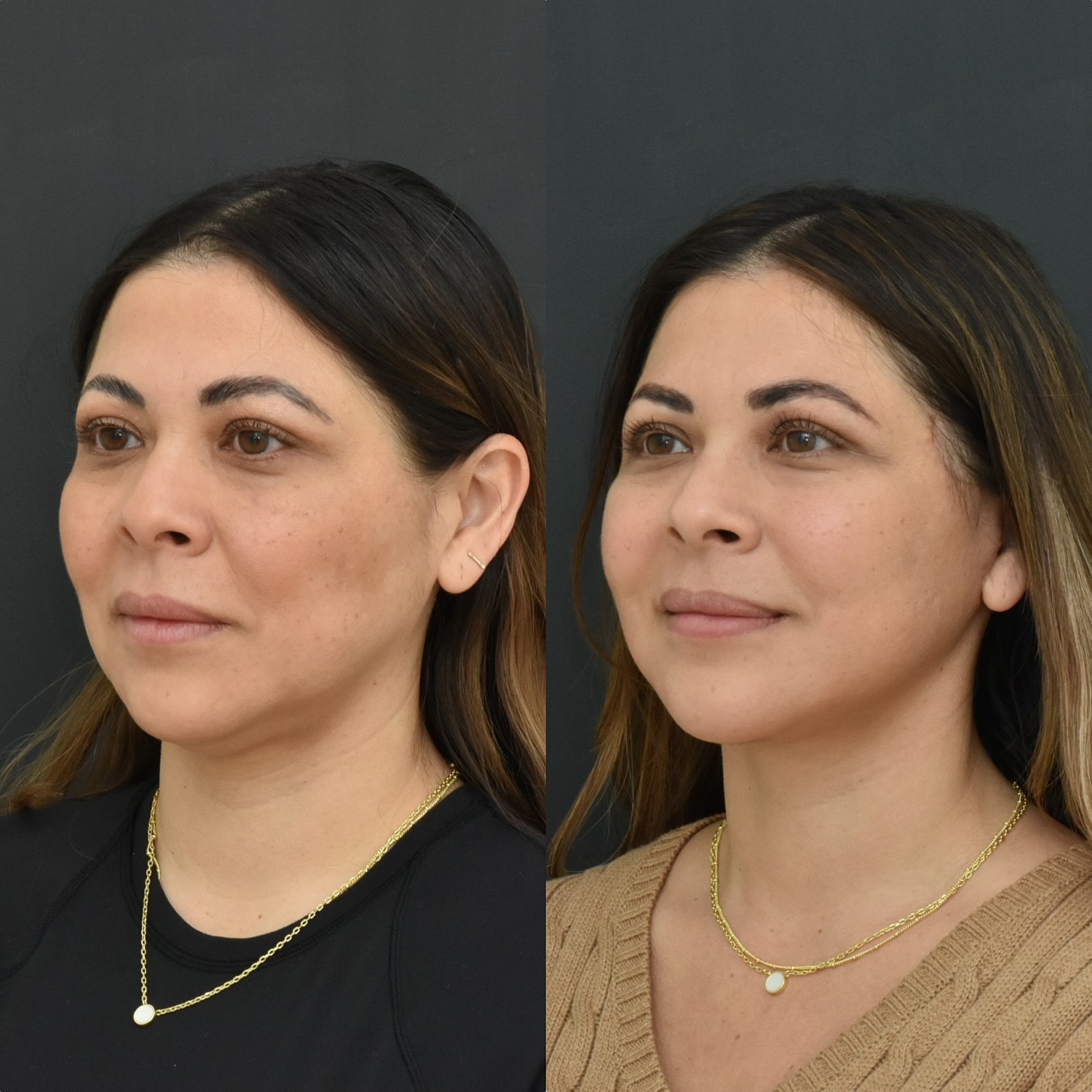 Facelift  Before & After