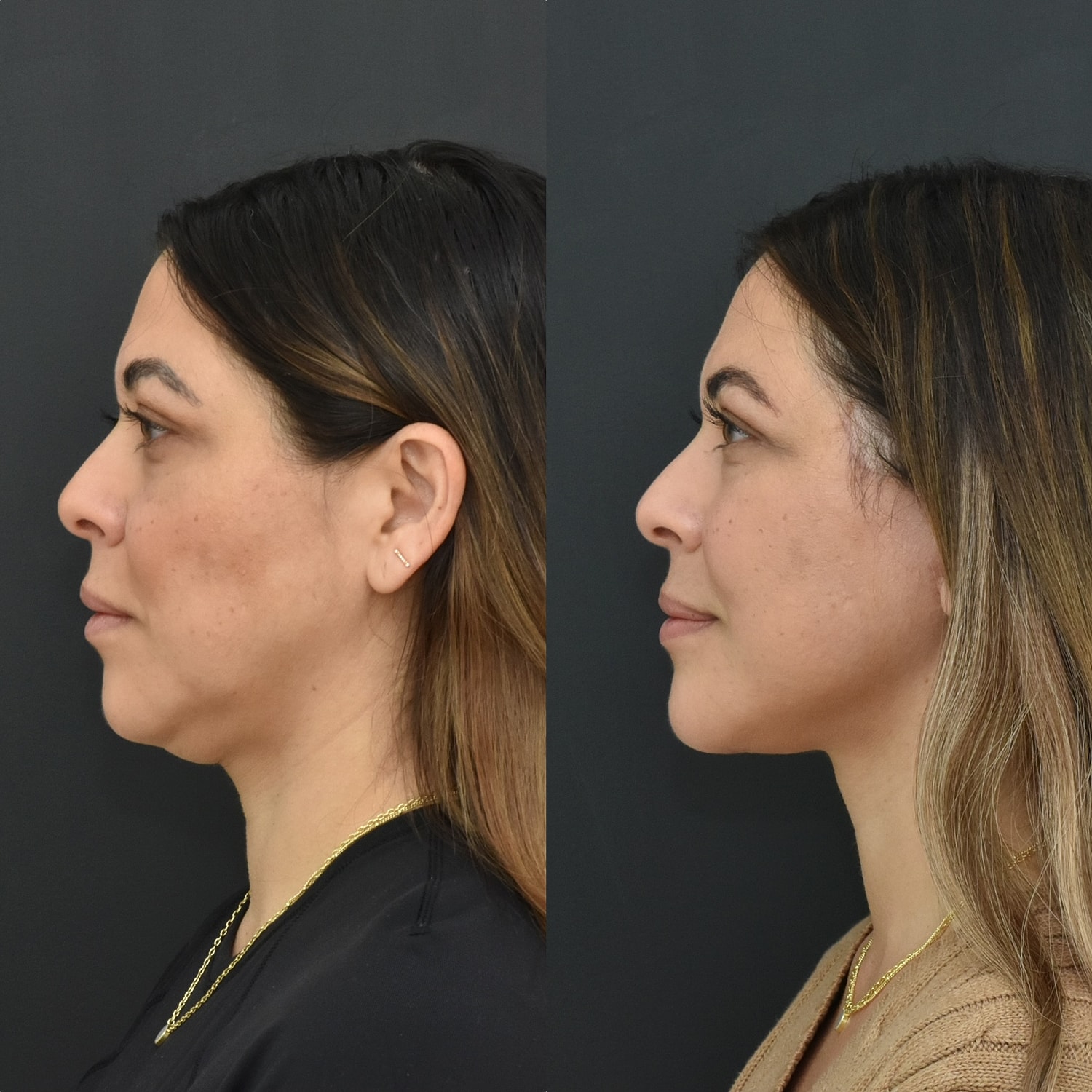 Facelift  Before & After