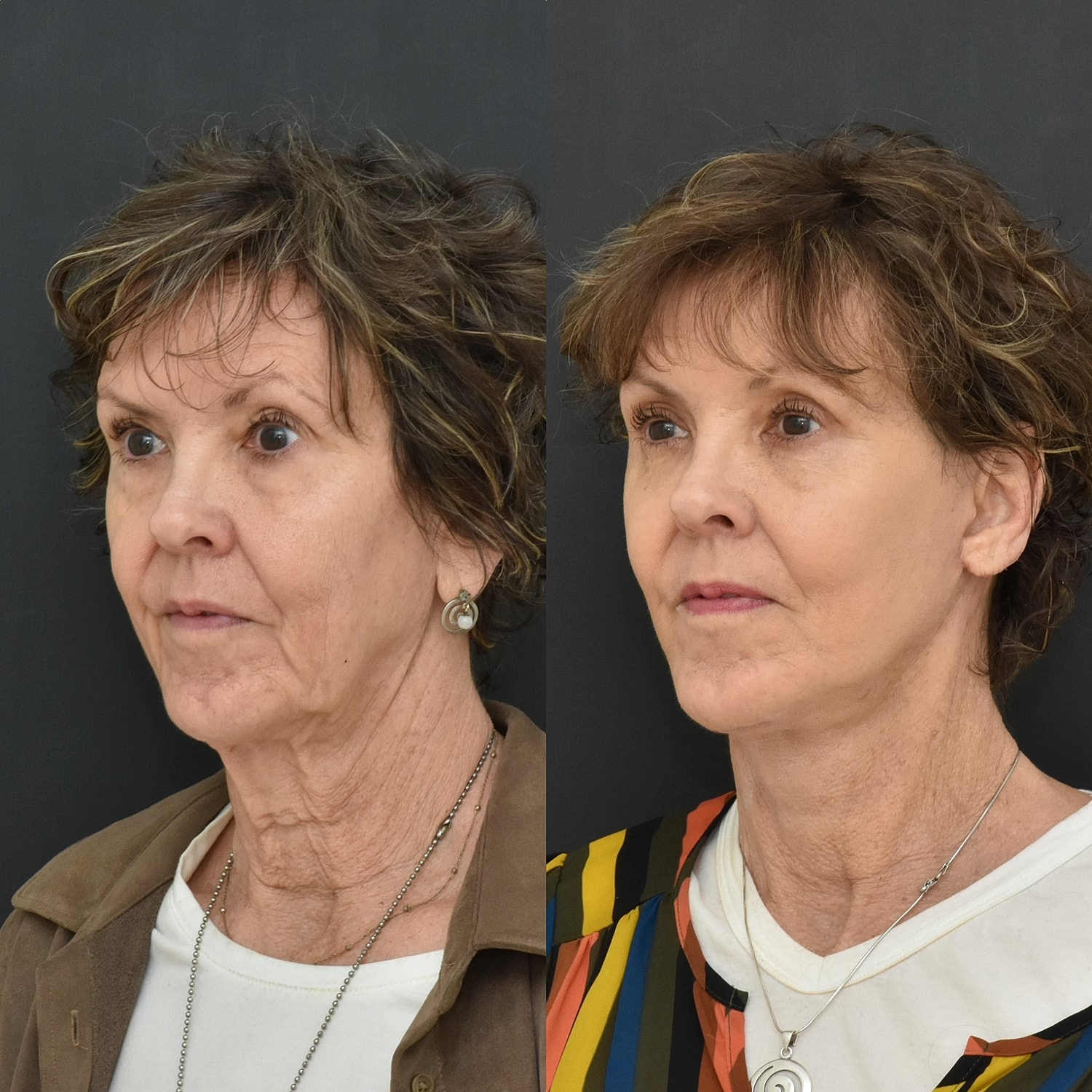 Facelift  Before & After