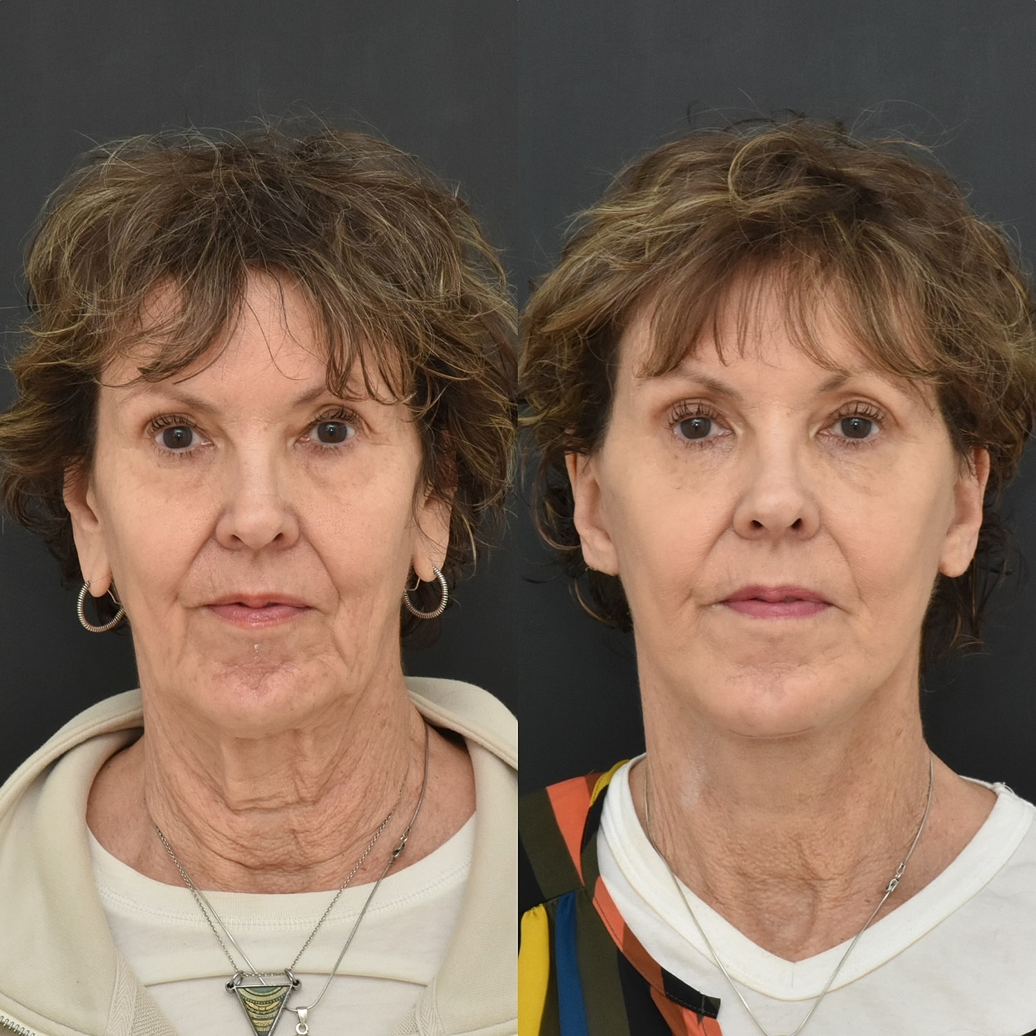 Facelift  Before & After