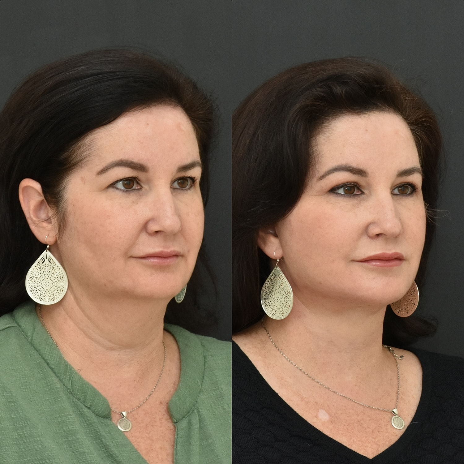 Facelift  Before & After