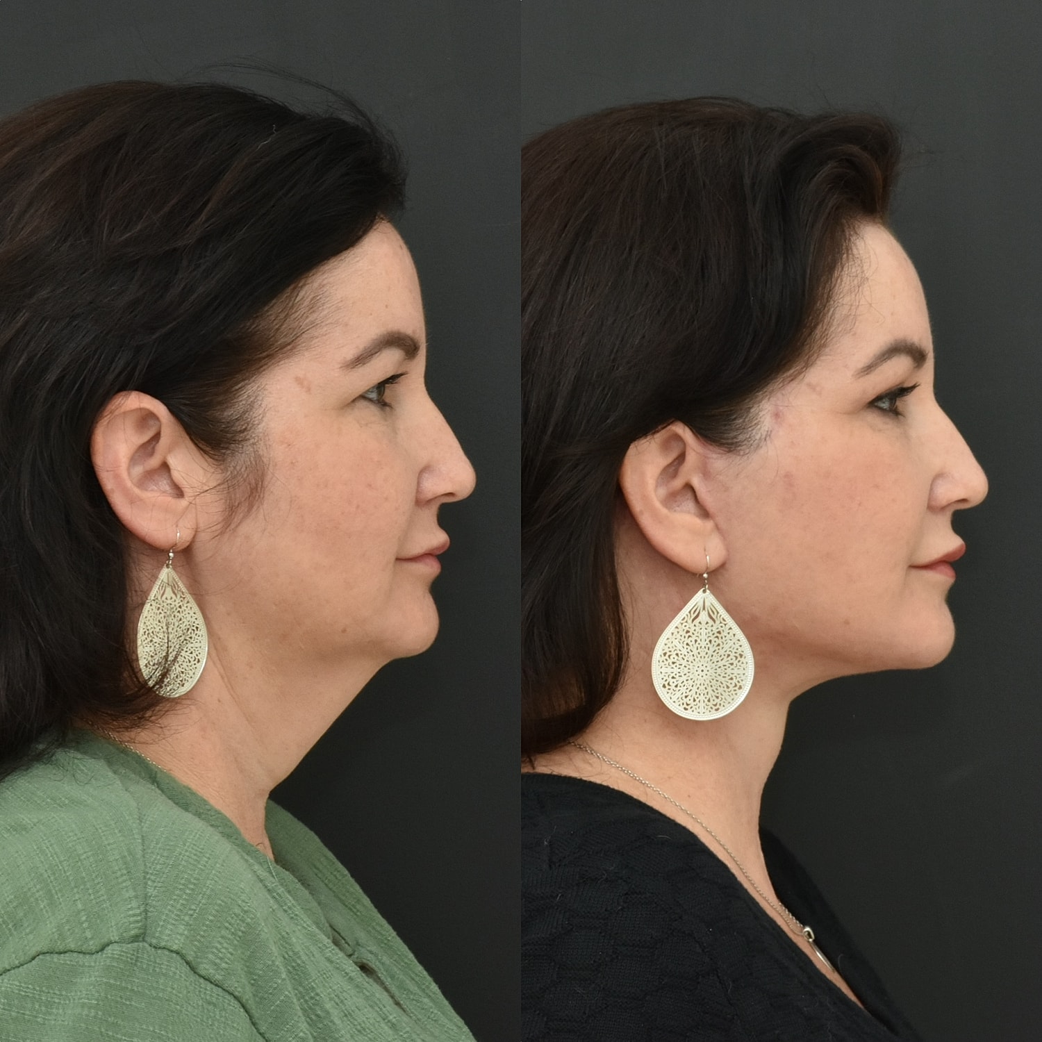 Facelift  Before & After
