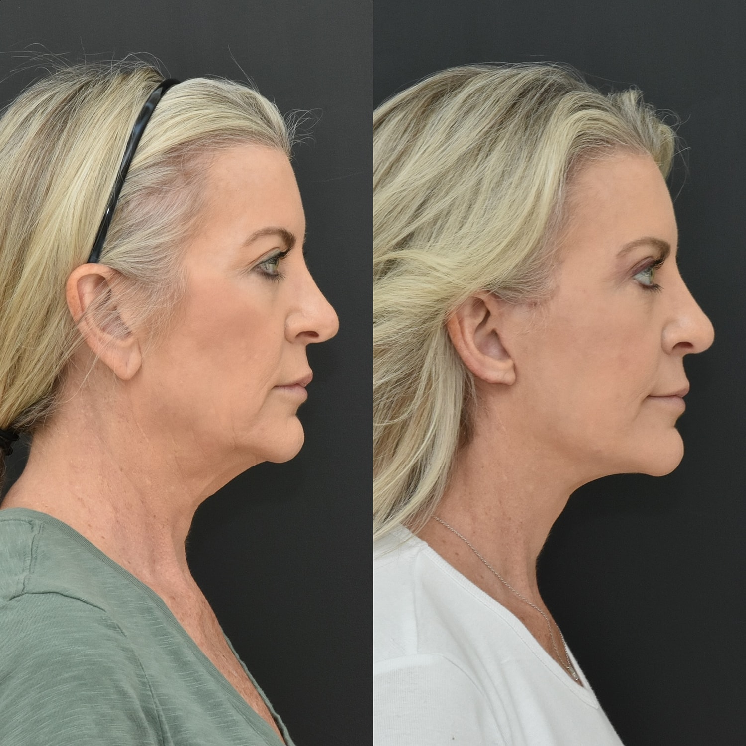Facelift  Before & After