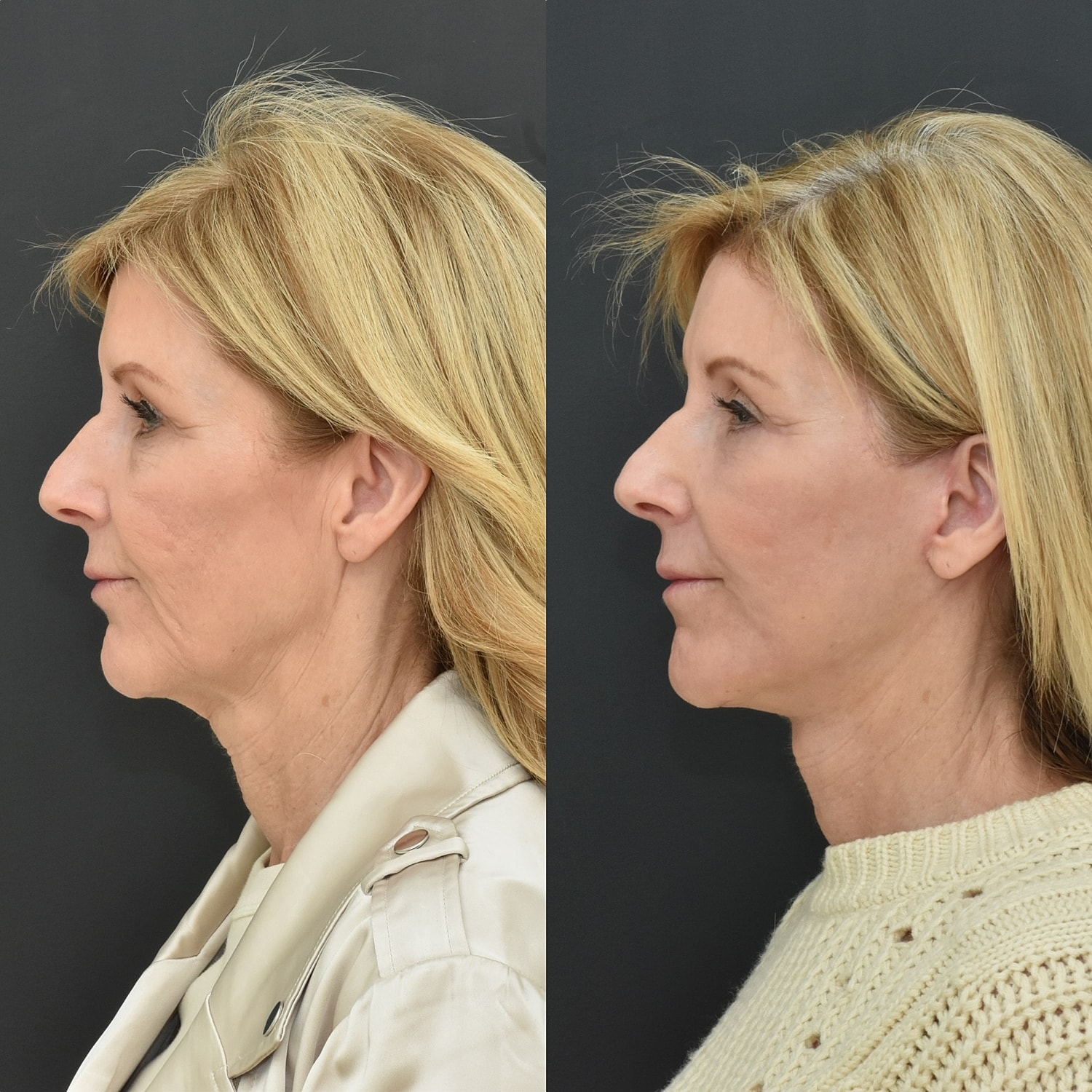 Facelift  Before & After