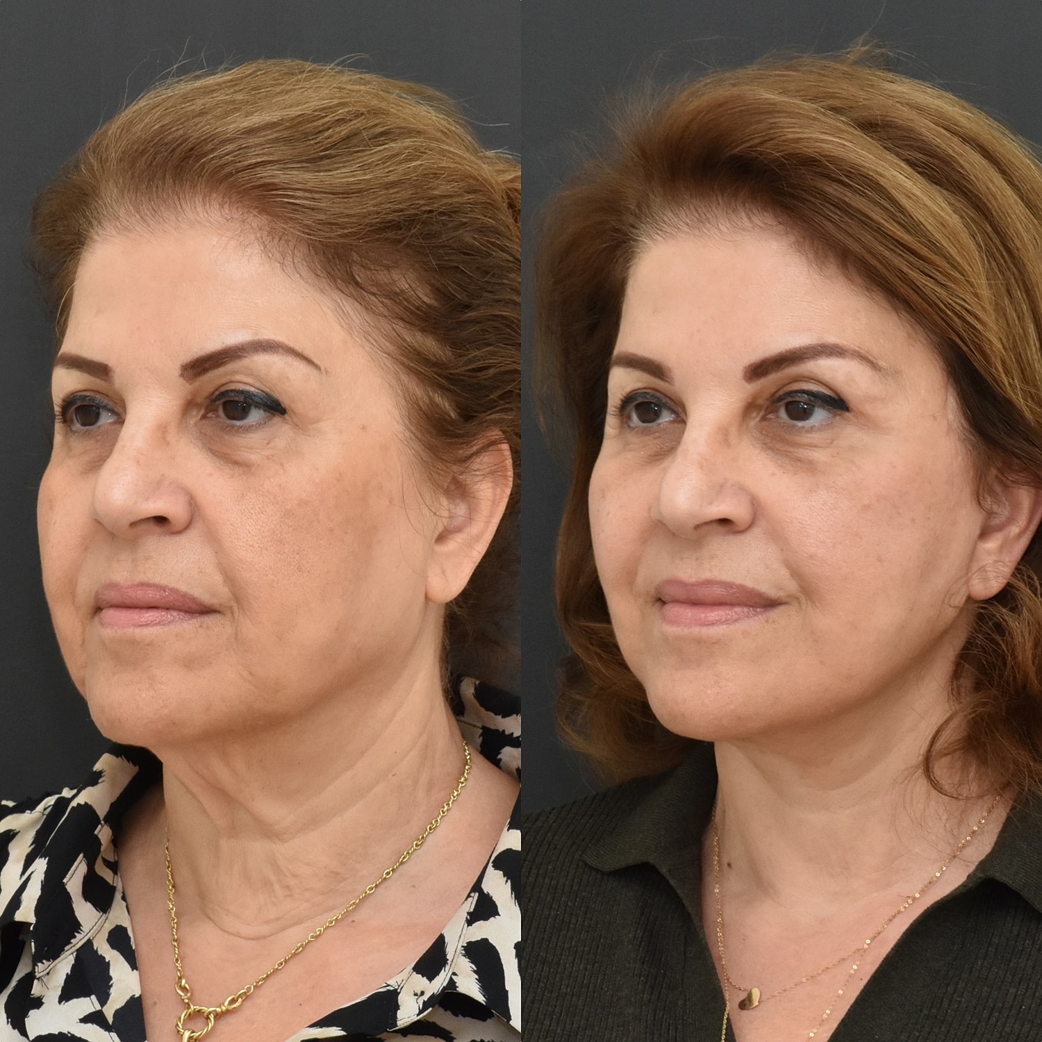 Facelift  Before & After