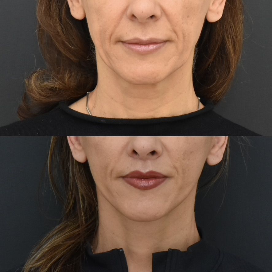 Lip Lift Before & After