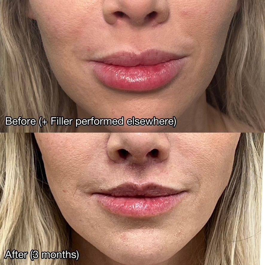 Lip Lift Before & After