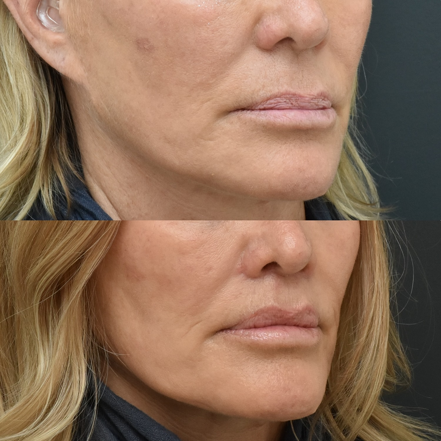 Lip Lift Before & After