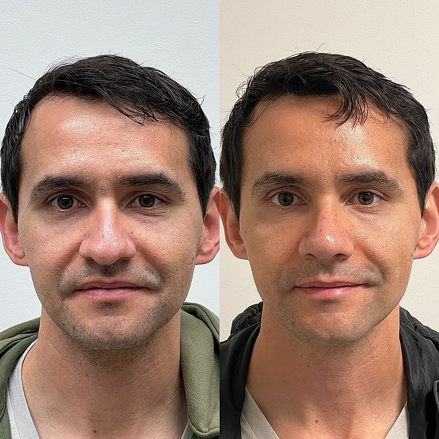 Rhinoplasty Before & After
