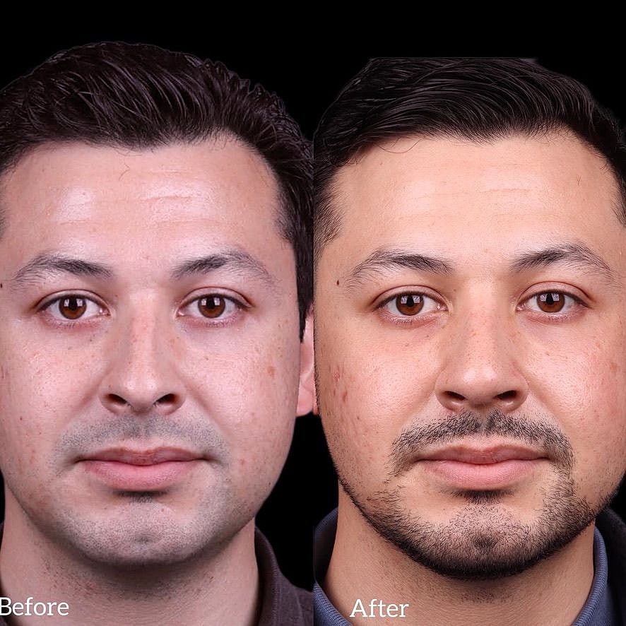 Rhinoplasty Before & After