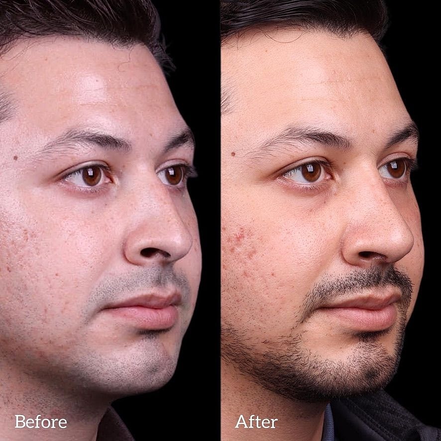 Rhinoplasty Before & After