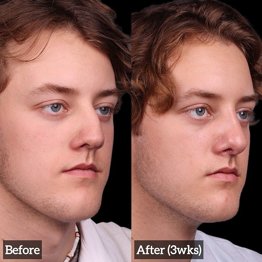 Rhinoplasty Before & After