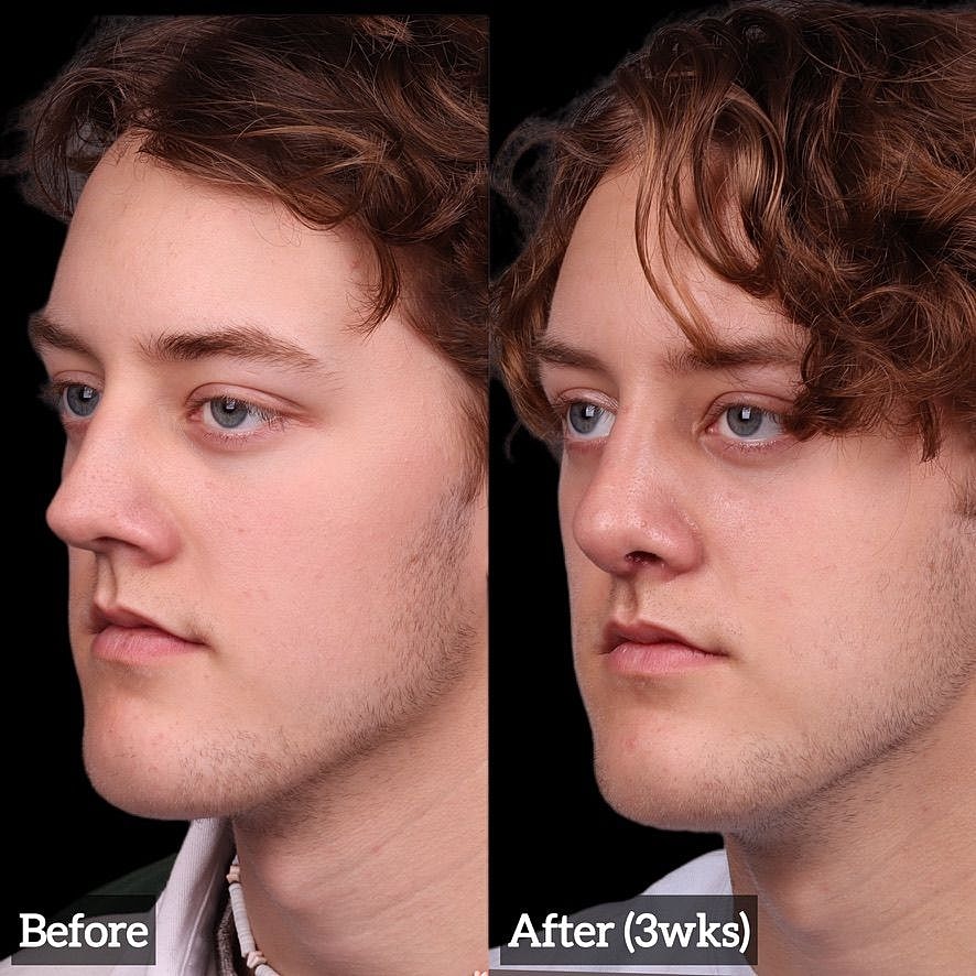 Rhinoplasty Before & After