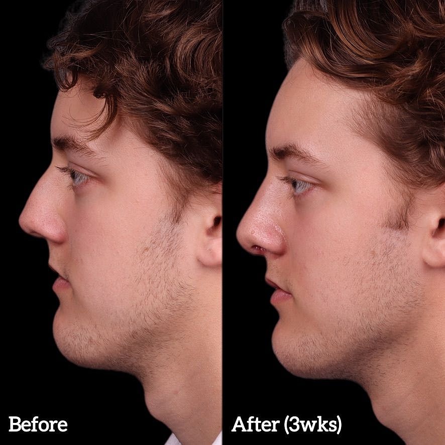 Rhinoplasty Before & After