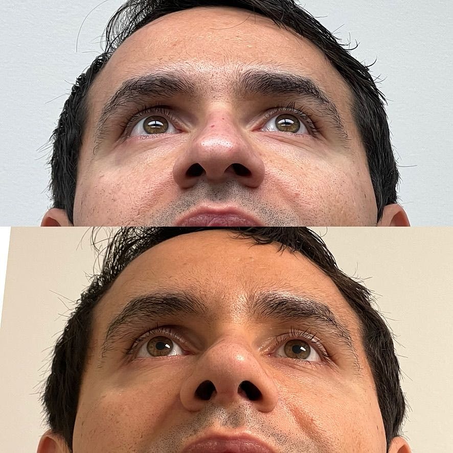 Rhinoplasty Before & After