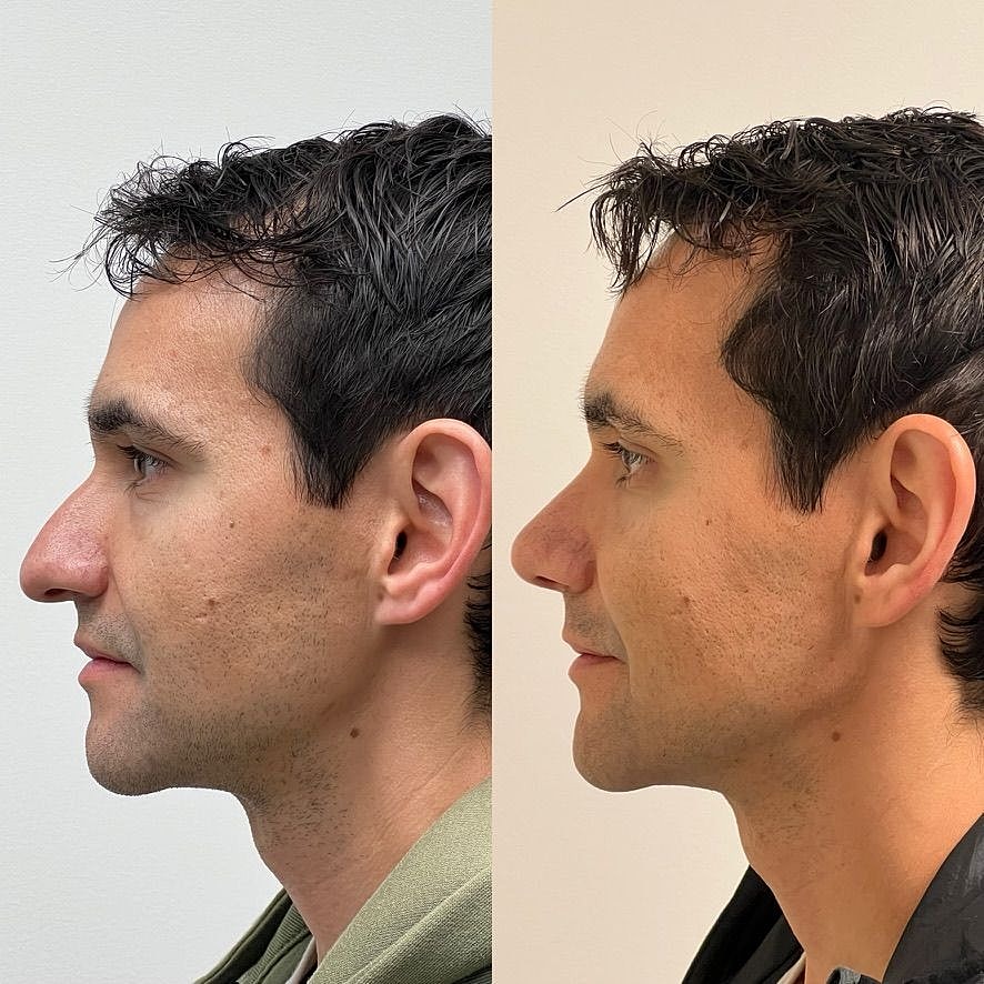 Rhinoplasty Before & After