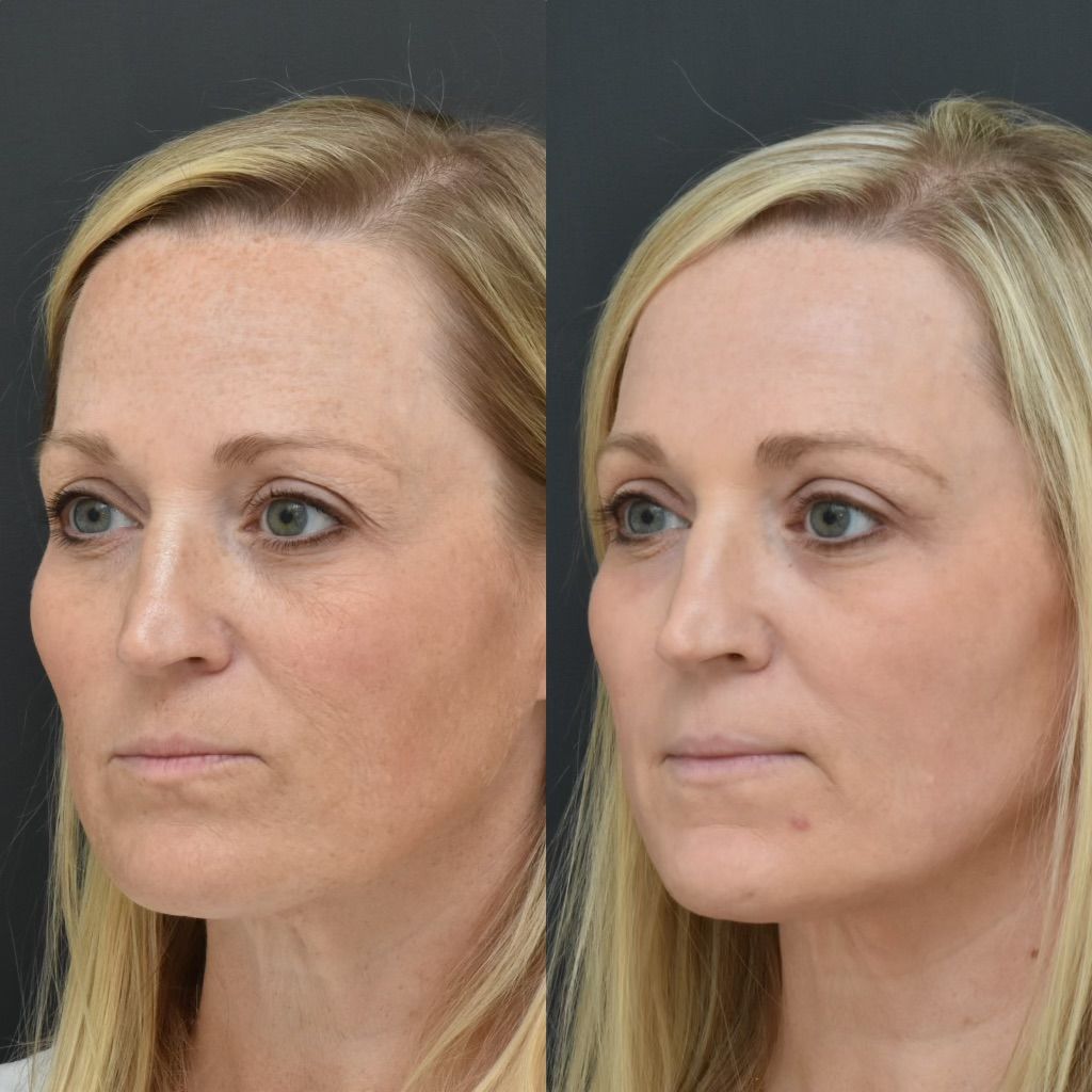 CO2 Laser Resurfacing Before & After