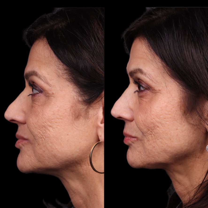 Facial Balancing Before & After