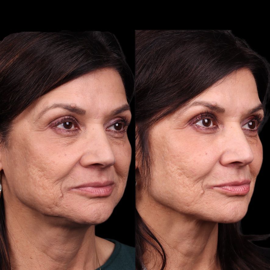 Facial Balancing Before & After