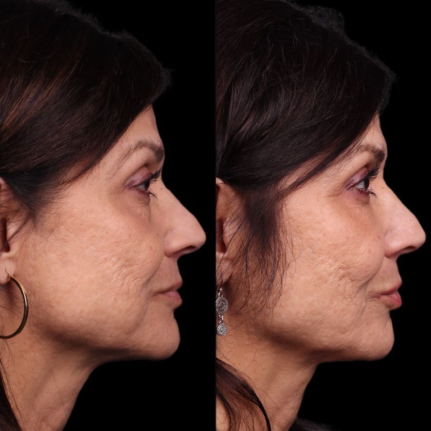 Facial Balancing Before & After
