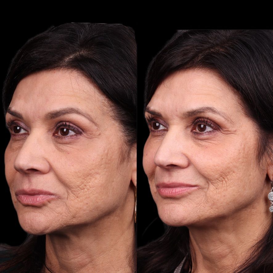 Facial Balancing Before & After