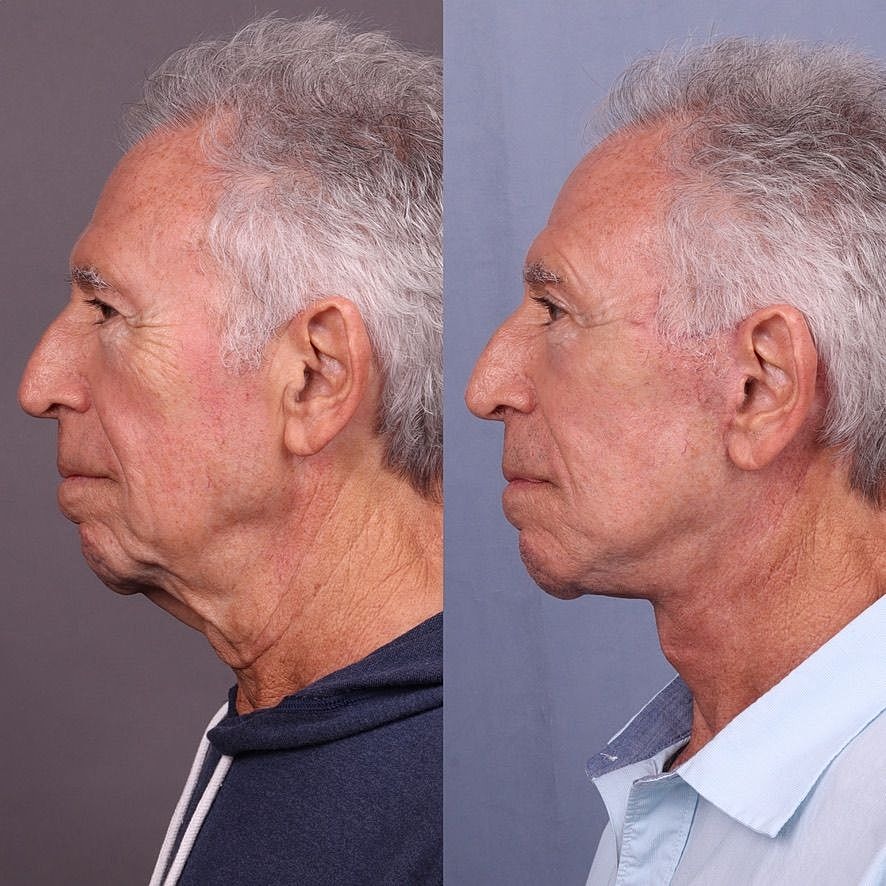 Male Facelifts Before & After