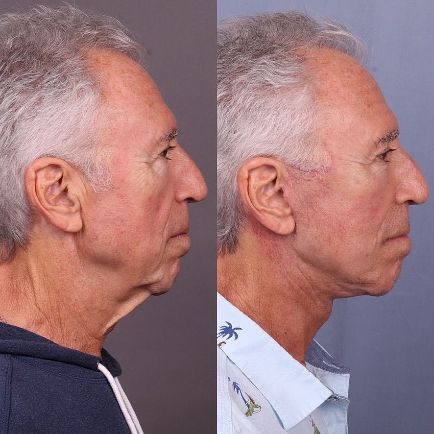 Male Facelifts Before & After